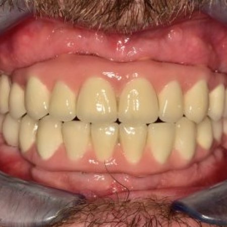 12 Nobel implantátumon nyugvó alsó és felső körhíd | Vitalitás Fogászati Központ, Budapest