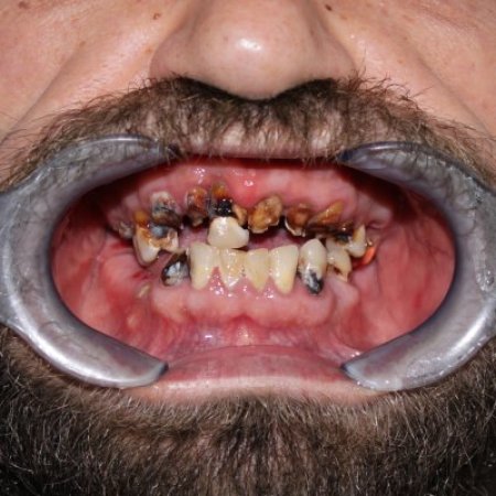 12 Nobel implantátumon nyugvó alsó és felső körhíd | Vitalitás Fogászati Központ, Budapest