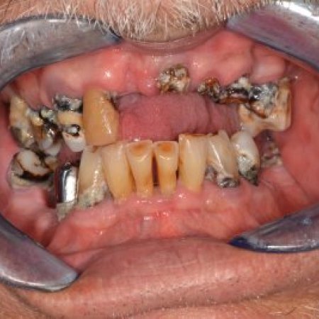 Teljes alsó és felső állcsontra négy implantátummal rögzített overdenture | Vitalitás Fogászati Központ, Budapest
