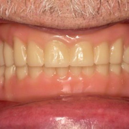 Teljes alsó és felső állcsontra négy implantátummal rögzített overdenture | Vitalitás Fogászati Központ, Budapest