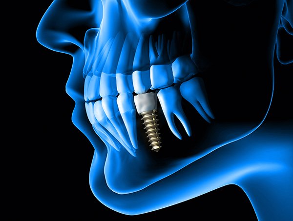 Fogászati implantátum