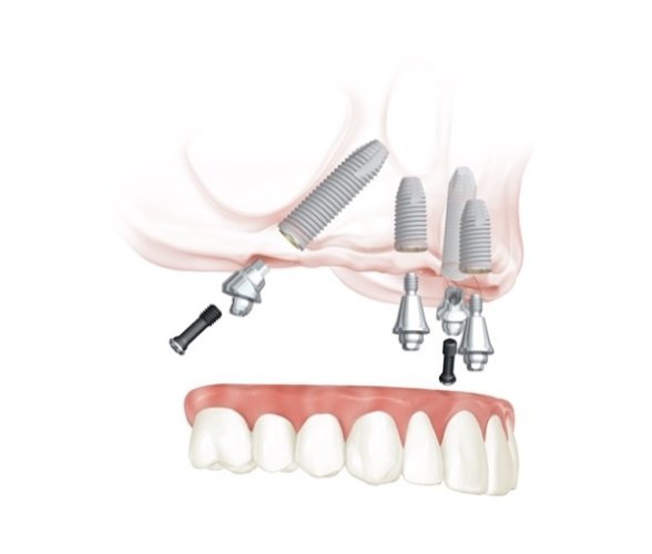 All-on-4 Maxilla NobelParallelCC