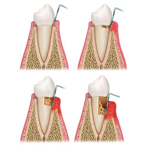 Parodontológiai kezelés