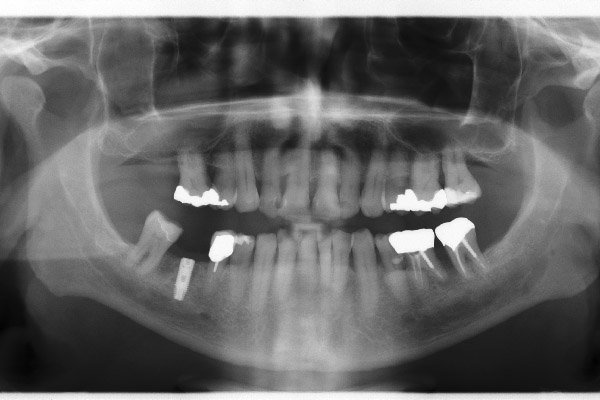 CBCT felvétel