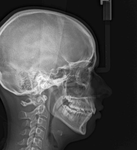 CBCT felvétel