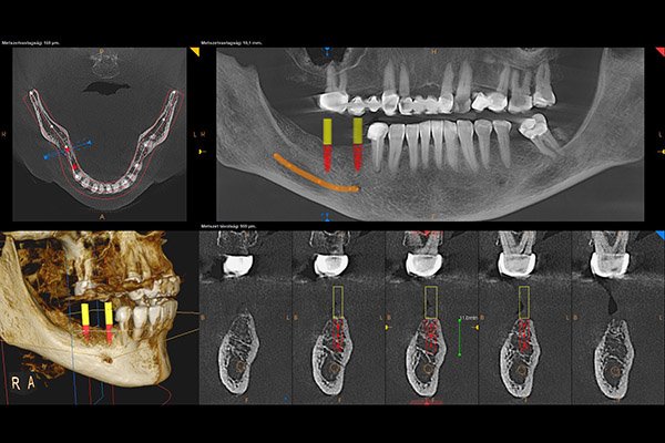 CBCT felvétel