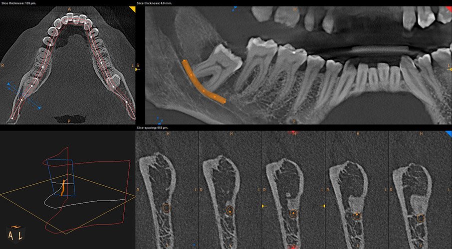 CBCT felvétel