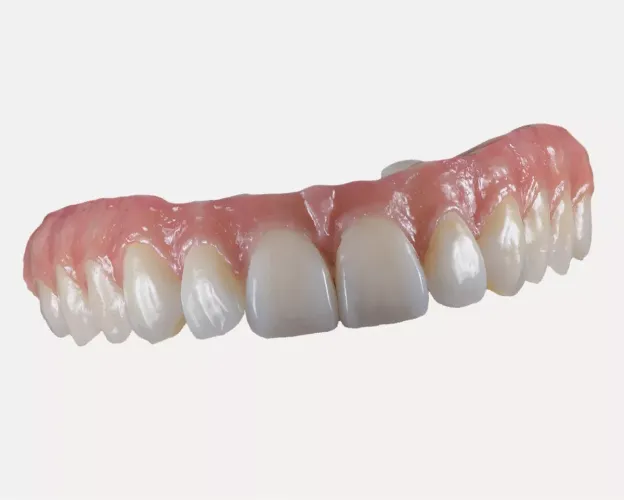 All-on-4 felső állkapocs