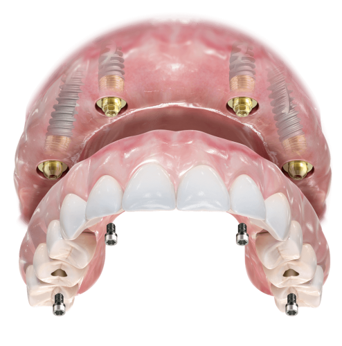 All-on-4 felső állkapocs