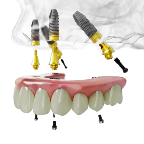 All-on-4 felső állkapocs