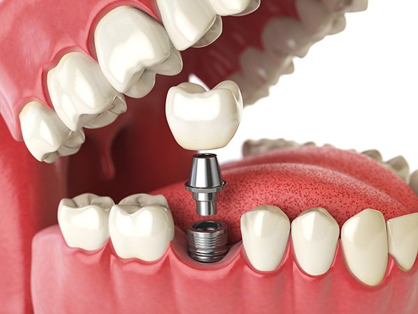 Egy fog pótlása implantkoronával